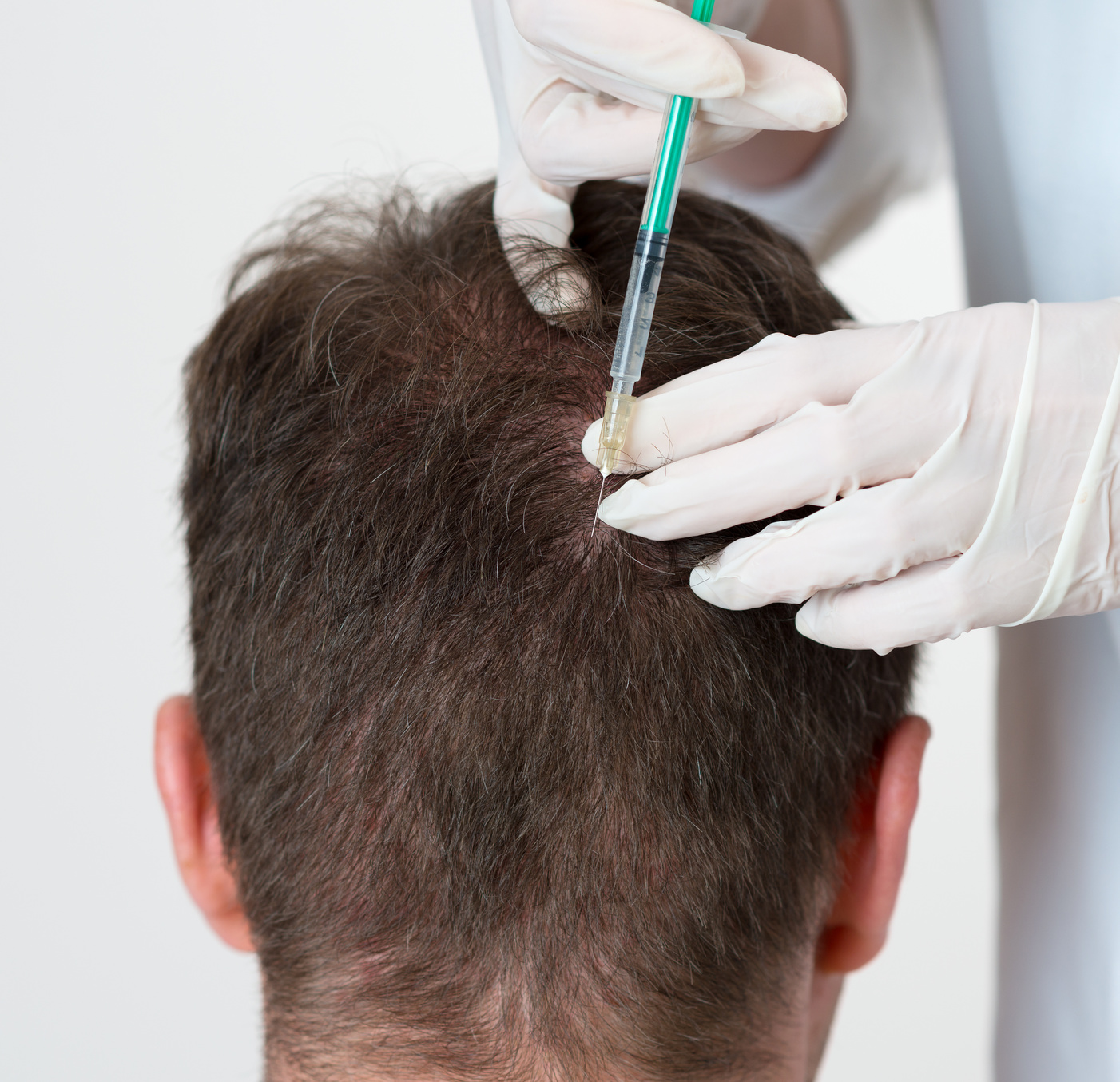 Alopezie (Haarausfall) Behandlung Mann