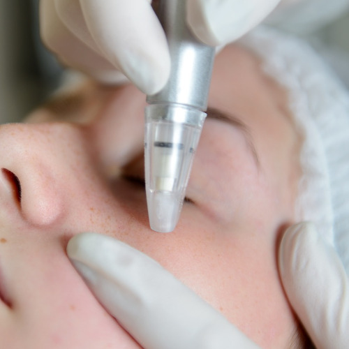 Microdermabrasion München