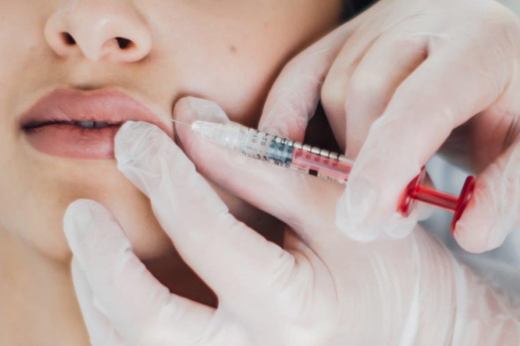 Lippenaufüllung Beaderm Behandlung