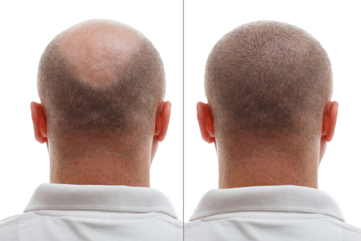 haarpigmentierung